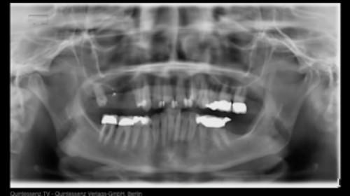 Innovative CAD/CAM treatment approaches for implant-supported fixed restorations